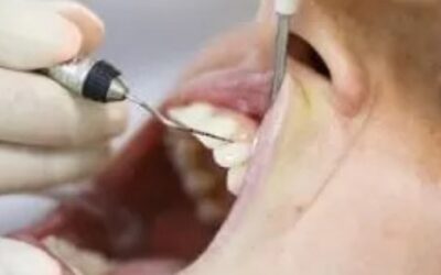 Treating Gum Recession With Grafting