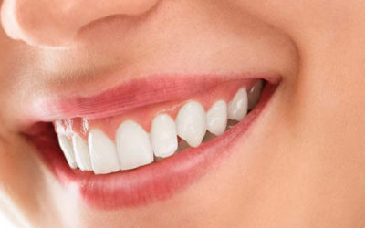 Are Your Gums Trying To Tell You Something?  And Why Do They Sometimes Bleed?