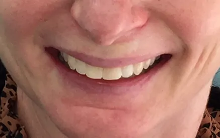Invisalign and Veneers in Chatswood 1 After