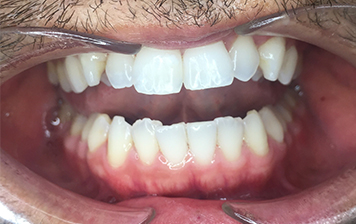 Invisalign and Veneers in Chatswood case 1 Before