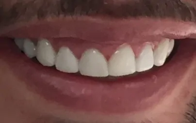 Porcelain Veneers in Chatswood case 3-2 After