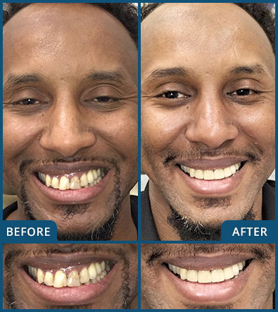 Veneers in Chatswood Case 5