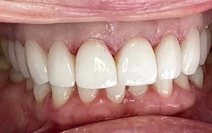 Porcelain Veneers in Chatswood case 2-2 After