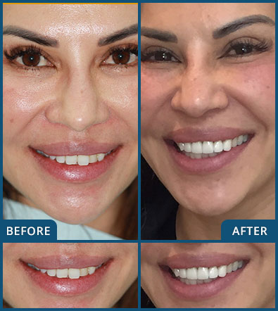 Veneers in Chatswood Case 1