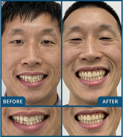 Invisalign in Chatswood Case 15