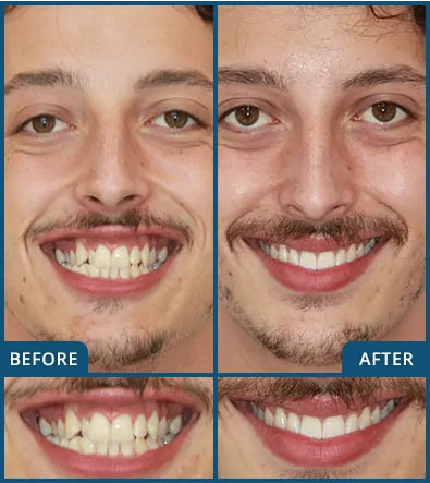 Invisalign in Chatswood Case 18