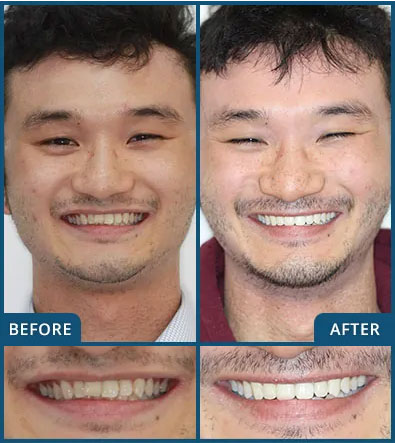 Invisalign in Chatswood Case 5