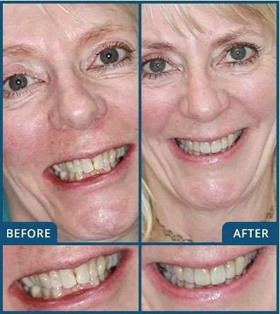 Invisalign in Chatswood Case 6