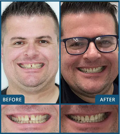 Invisalign in Chatswood Case 7