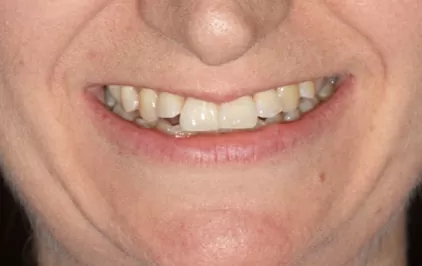 Invisalign in Chatswood case 1-1 Before