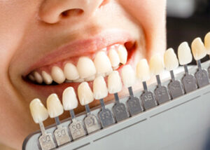 benefits veneers cosmetic chatswood