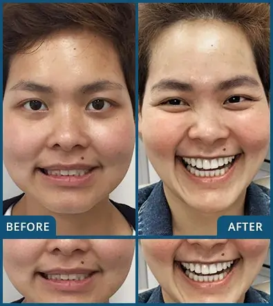 Invisalign in Chatswood Case 20