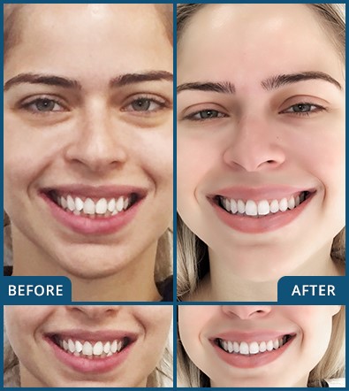 Invisalign in Chatswood Case 1 new