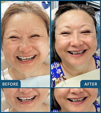 Veneers in Chatswood Case 3