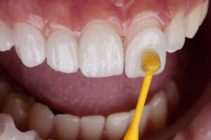advantages cons veneers dental chatswood