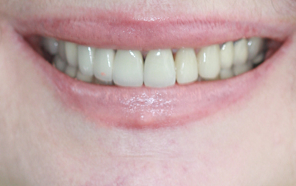 Porcelain Veneers in Chatswood Case 10 After