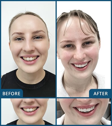 Veneers in Chatswood Case 11