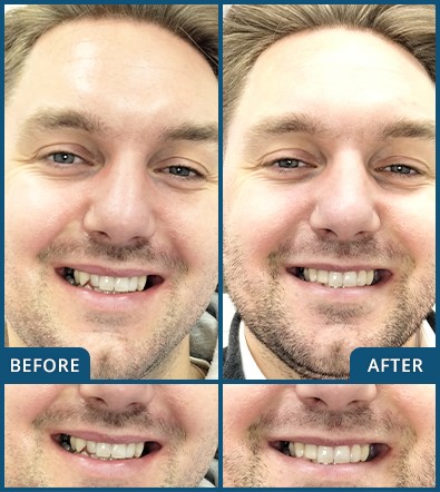 Composite Veneers in Chatswood Case 6