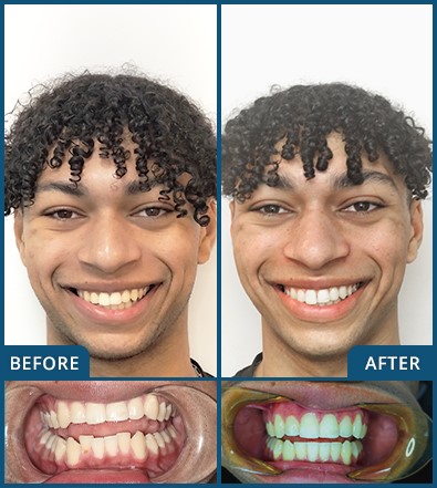 Invisalign in Chatswood Case 23