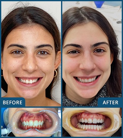 Invisalign in Chatswood Case 24