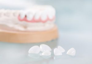 evaluating costs dental veneers chatswood