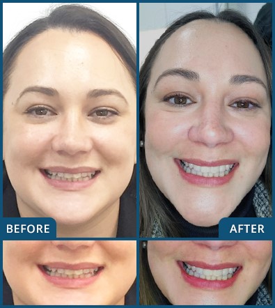 Invisalign in Chatswood Case 25