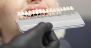 procedure veneers crowns guide