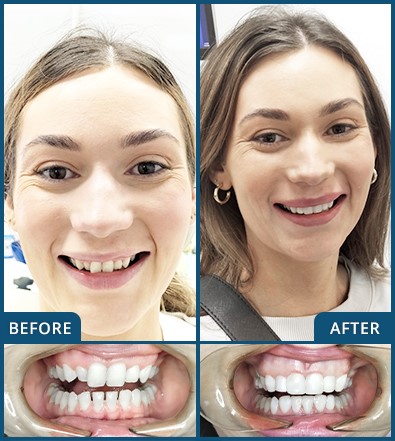 Composite Veneers in Chatswood Case 7-6