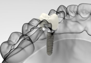 implant placement chatswood