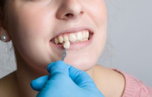 Veneers cost Turkey consideration