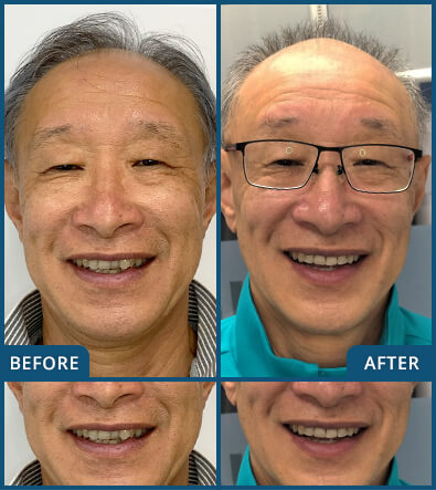 Invisalign in Chatswood Case 26