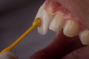 teeth veneers cost australia process