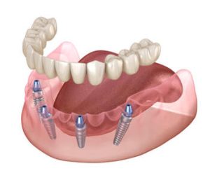 All On 4 Dental Implants look chatswood