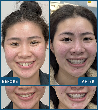 Invisalign in Chatswood Case 28