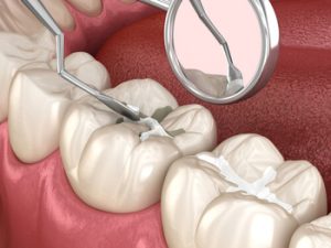 Alternative to Veneers dental bonding chatswood