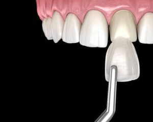 Alternative to Veneers procedure chatswood