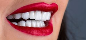 Full Set Of Veneers Cost results chatswood