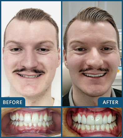 Porcelain Veneers in Chatswood Case 12