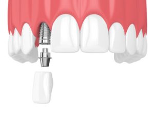 bali dental implant procedure chatswood