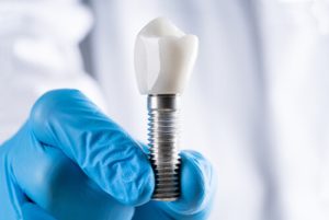 bali dental implant types chatswood