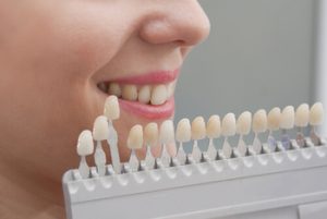 what are porcelain veneers teeth colour chatswood
