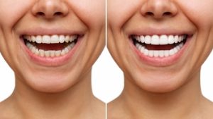 after procedure of porcelain-veneers chatswood