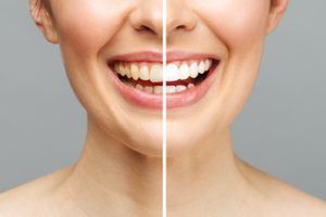 look after porcelain veneers chatswood