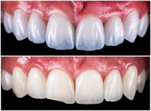 process in getting veneers chatswood
