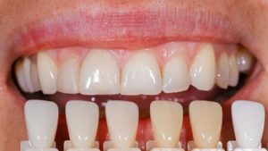 time span to get veneers chatswood