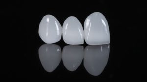 Affordable Dental Veneers use chatswood