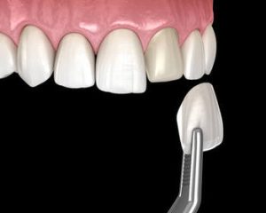 Lumineers Vs Veneers application chatswood