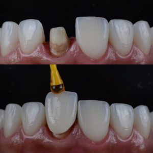 do veneers damage teeth process chatswood