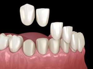 do veneers damage teeth shells chatswood