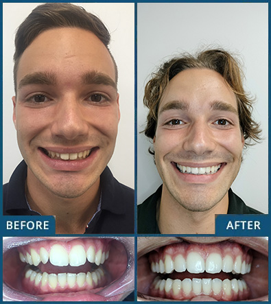 Invisalign in Chatswood Case 30